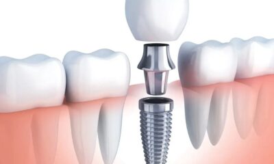 Dental Implants