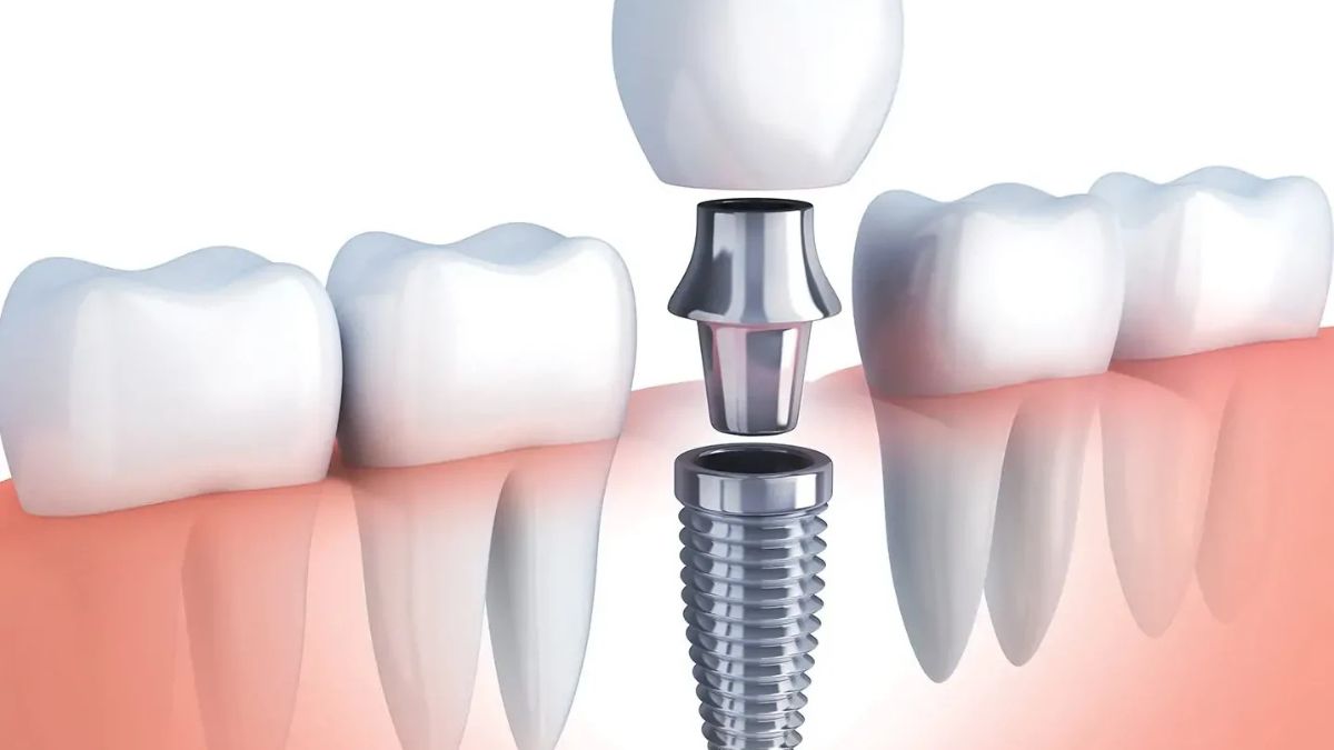 Dental Implants