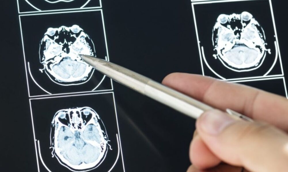 5 Losses That Must Be Included in a Brain Injury Claim