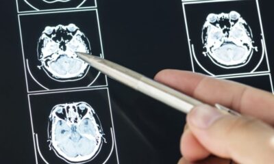 5 Losses That Must Be Included in a Brain Injury Claim