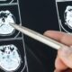 5 Losses That Must Be Included in a Brain Injury Claim