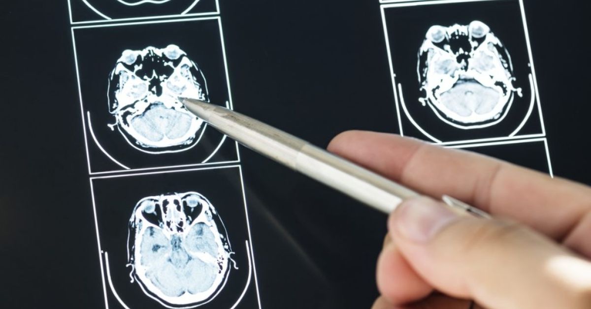 5 Losses That Must Be Included in a Brain Injury Claim